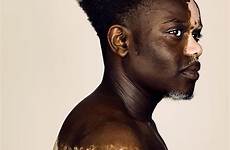 vitiligo model aziz people bashir skin difference beauty human finding opens living vice choose board