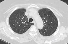 ct lung window scan figure movie scanning gif swjpcc thoracic representative click here
