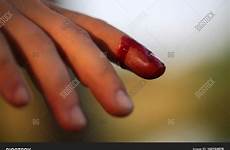 finger bleeding trial right