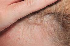 psoriasis scalp genital flaky symptoms itchy eczema dandruff