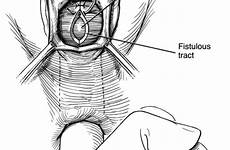 vaginal rectovaginal repair fistulas treatment colorectal surgical jcm demonstrating technique anatomical low illustration figure mdpi novel modalities imaging interventional