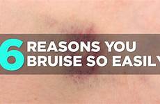 easily bruise bruising so why do health skin reasons conditions