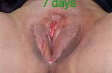 male vaginoplasty transsexual implants