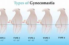 gynecomastia surgery breast fat pseudo enlarged ginecomastia