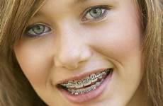 braces silver girl young orthodontic teeth teenage powerchain teenagers faq woman orthodontics upper