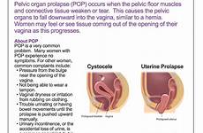 prolapse pelvic organ augs floor fact pop sheets patient large bladder symptoms sacrocolpopexy treatment print exercises recovery