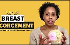 breast engorgement postpartum