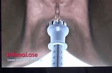 laser vaginal tightening operation