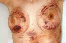 bruises breast kink harder
