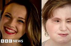 katie face stubblefield bbc daughter transplant coping before after shot her she now duration