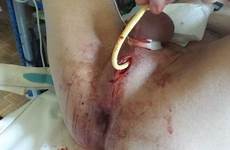 urethral reroute scrotum nackte junge maedchen pee feminization hermaphrodite
