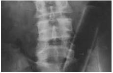 foreign body rectal removal radiography periprocedural care visible readily
