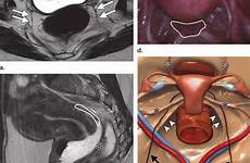 anatomy pelvis axial sagittal uterosacral weighted laparoscopic ligaments rectovaginal cardinal