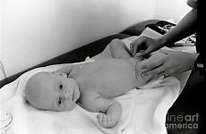 testicles examination paediatric henny babys allis