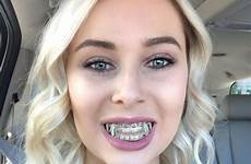 braces elastics teeth brace cute brackets girl grillz metal dentales piercings selfies 3m hair casts diydecors sekiz