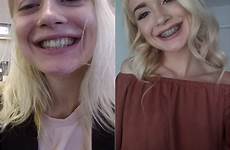 anastasia knight teen her face brace braces facial anyone forward looking comments tf themed sign some reddit braceface first cumshot