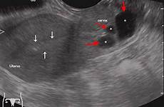 cyst nabothian cervix ultrasound cysts uterus arrows endometrial healthjade