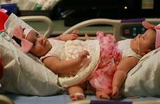 conjoined twins sisters separated birth surgery texas cnn rare separation facts connected fast were re their