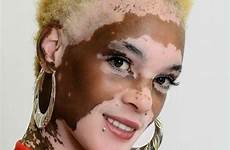 vitiligo albino fixmage feed