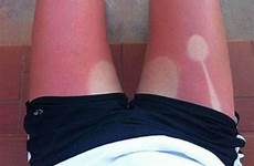 sunburn worst tans wrong gone cuidado nalgas quemadas chica sunscreen regret pele bizarras examples voolas spoon