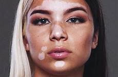 vitiligo unique freckles