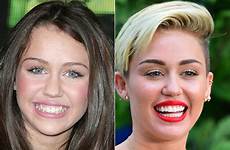 miley before after dental celebrities cyrus transformations toothy gone