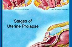 prolapse pelvic organ uterine surgery