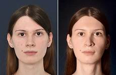 feminization ffs nicole 2pass nose feminisierung nicky transwomen tracheal shave rhinoplasty gesichts