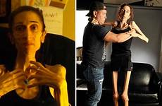 anorexic rachael woman anorexia farrokh after treatment thanks 200k donors raising nearly severe disorders eating who actress chicago body