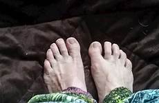 curling toes clubfoot