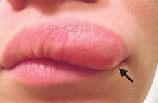lip skin face lump worm itchy swollen after under upper woman small her when normal she size than mysterious parasitic