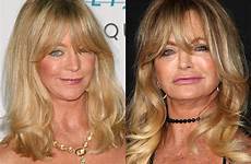 goldie hawn implants filler yournextshoes flawless maintain receiving peels chemical