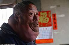 fat man neck growth chinese old help plea makes villager giant liu has treatment his year donate costs farmer calling
