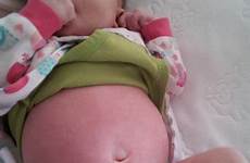 bloated tummy babycenter bulging seems
