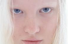 albino woman pale girl linn hair swedish skin models newfaces classify platinum blonde young natural albinism modelo women beauty model