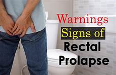 prolapse rectal symptoms