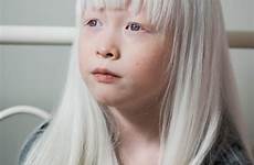albinism albino adopting theeverymom finley