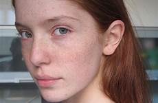 freckles mdel hair
