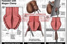 foreskin clamp mogen excision 01x proper medical