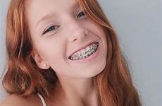 redheads freckles braces stunningly