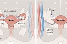 uterus pregnancy pregnant women transplants become lactation help some large