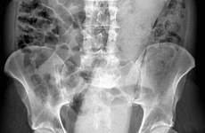 ray fist vagina xray fisting stuck weird compiles rectum corpo rays insertion umano radiografie pazze che