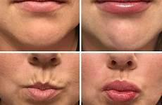 fillers lip dermal filler after before proficient shapely removing wrinkle plumper