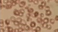 The video shows the clumping of red blood cells in a positive cross-match test.