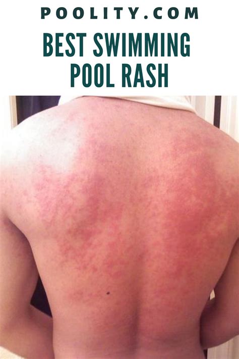 Can Chlorine In A Swimming Pool Cause A Rash at Stephan Byrd blog