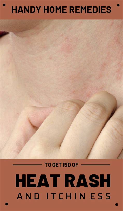 Handy Home Remedies To Get Rid Of Heat Rash And Itchiness ...