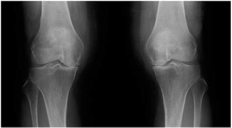 Subchondral Insufficiency Fracture of the Femoral Head ...
