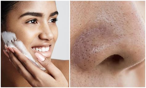 Dengan aloe vera & 16 bahan semulajadi… Jangan Picit Dah! Ini 5 Cara Mudah Hilangkan Blackhead ...