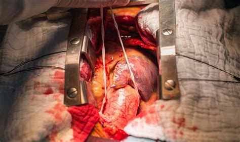 O aneurisma cerebral se desenvolvem com o enfraquecimento da parede de um vaso sanguíneo. ANEURISMA DA AORTA ABDOMINAL - Causas, Sintomas e ...