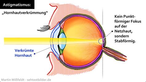 Mit speziellen sehhilfen lässt sie sich häufig ausgleichen. Ametropie